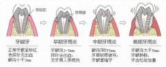 牙体缺损修复的注意事项