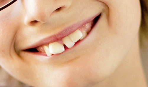 怎么区分龅牙是骨性还是牙性?