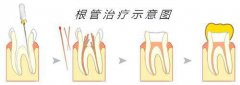 牙髓炎有哪些治疗方法及治疗原则?