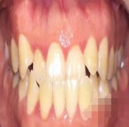 隐形牙套矫正，术后变化很明显