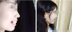 牙齿不齐怕人笑话？有了隐形矫正不再担心