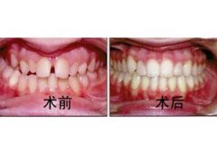 牙齿不对称？甚至影响说普通话