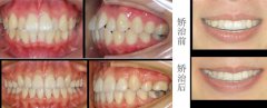 “虎牙”变整齐，笑的才肆意!