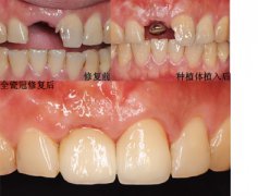找回“丢失牙”跟说话漏风说再见